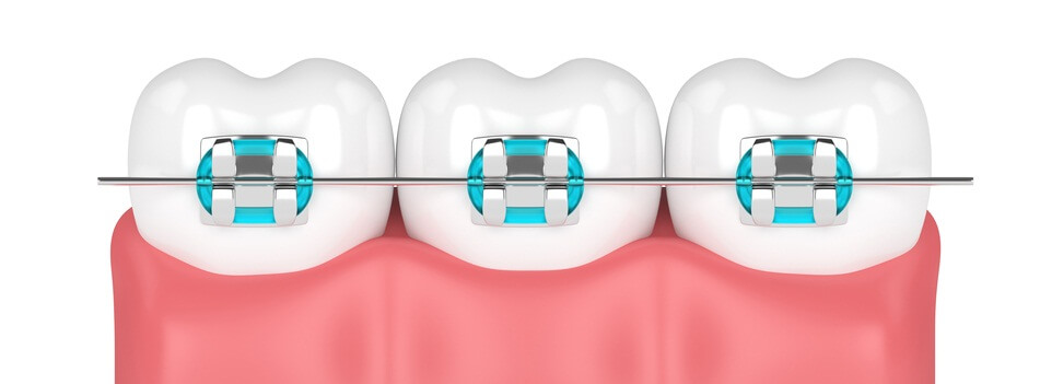 , Fastbraces, Chennai Orthodontics
