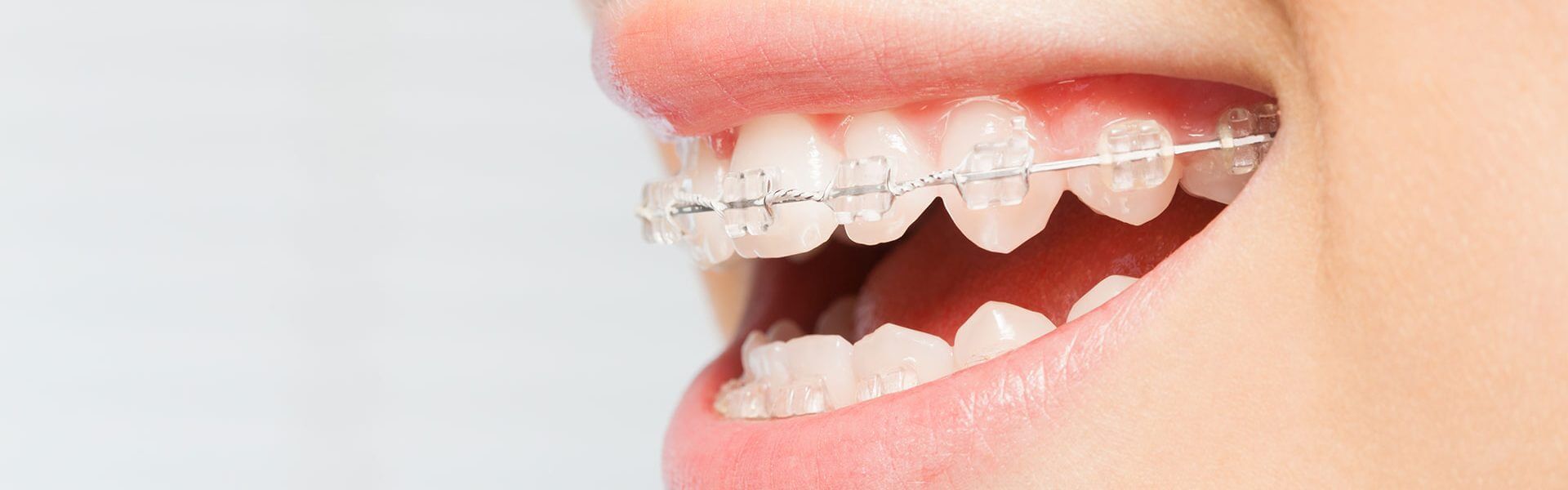 , Fastbraces, Chennai Orthodontics
