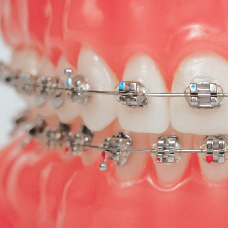 Traditional fixed braces, Traditional Fixed Braces, Chennai Orthodontics