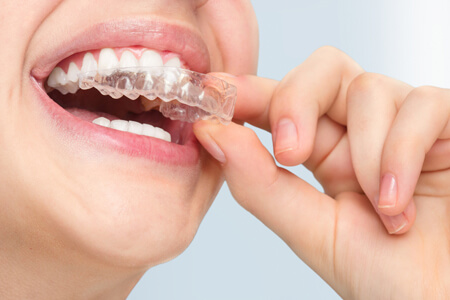 Why tooth aligners are costly ? Chennai Orthodontics