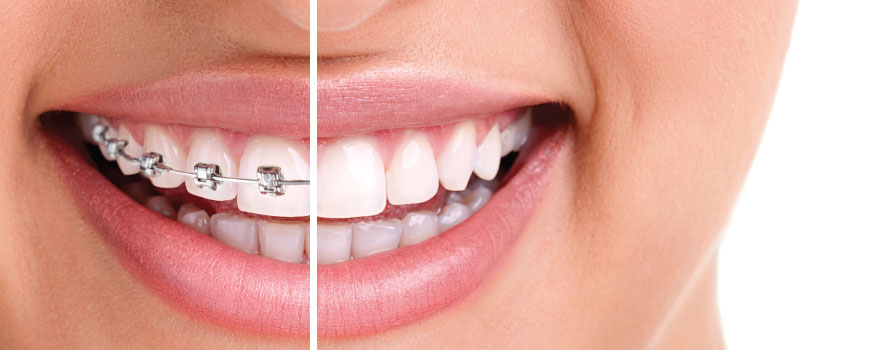 Lingual Braces - West Side Orthodontics