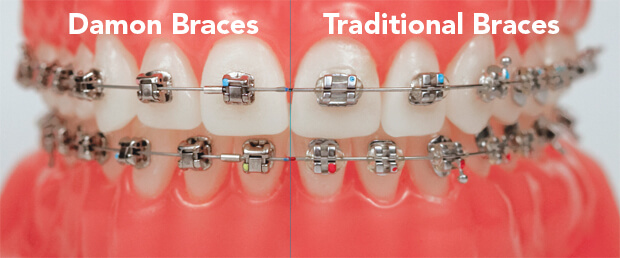 Comparative Damon braces Vs Traditional braces Image